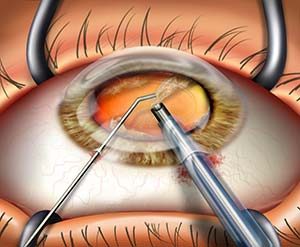phacoemulsification