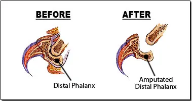 dcl_removal
